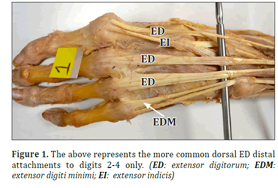 Documented Variations Of Extensor Digitorum Attachments The New Normal