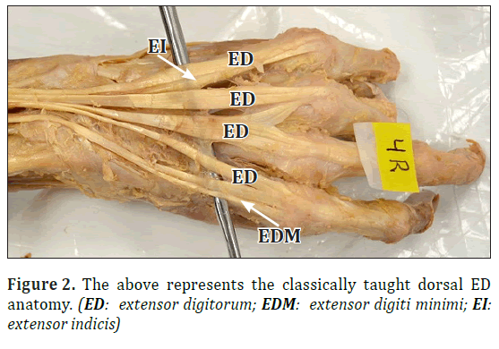 Documented Variations Of Extensor Digitorum Attachments The New Normal