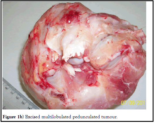 histopathol-pedunculated