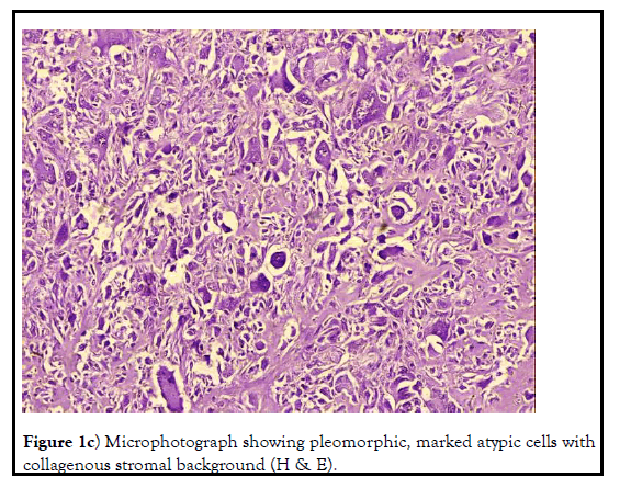 histopathol-pleomorphic