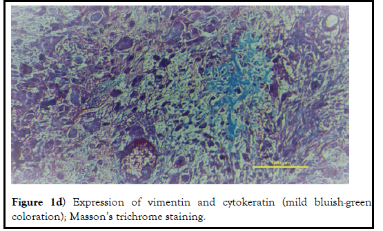 histopathol-vimentin