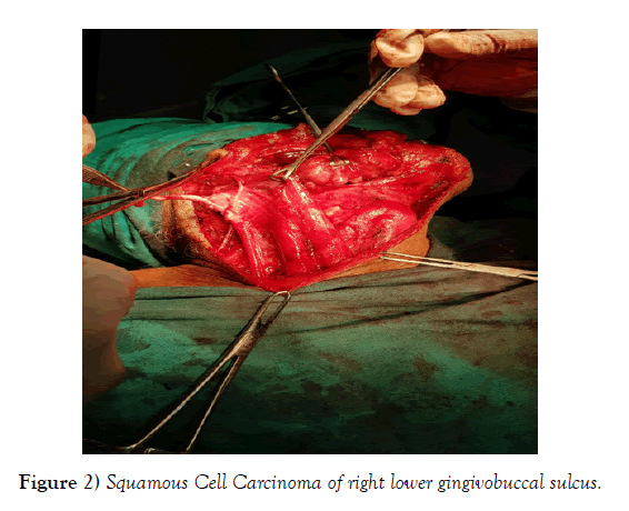 international-journal-anatomical-variations-Carcinoma