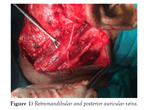 international-journal-anatomical-variations-auricular-veins