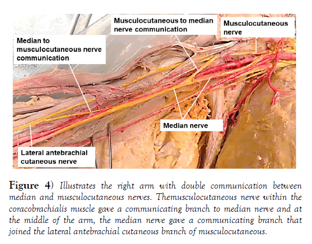 international-journal-anatomical-variations-musculocutaneous