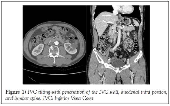 duodenal