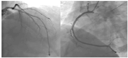 clinical-cardiology-Stenosis