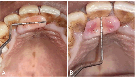 puldcr-palatal