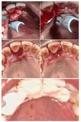 puldcr-periosteum