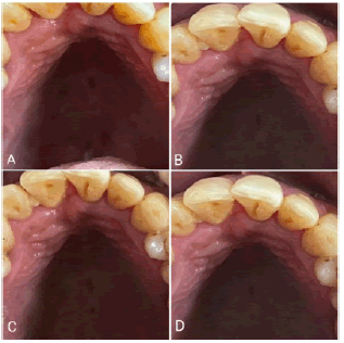 puldcr-postoperative