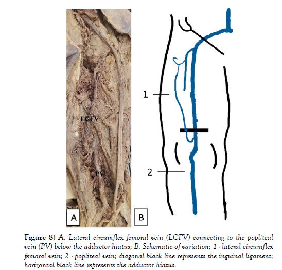 international-journal-anatomical-variations-Lateral