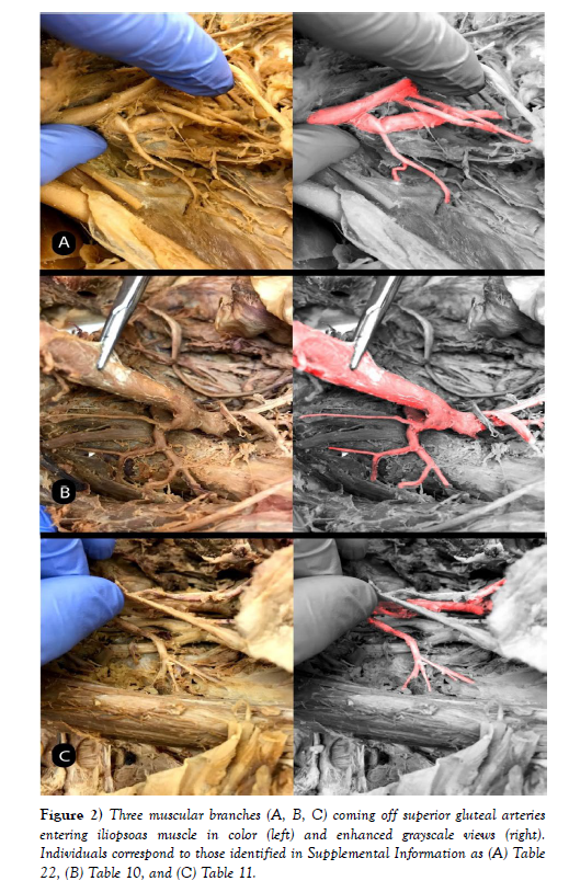 international-journal-anatomical-variations-Three