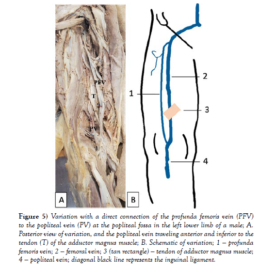 international-journal-anatomical-variations-femoris