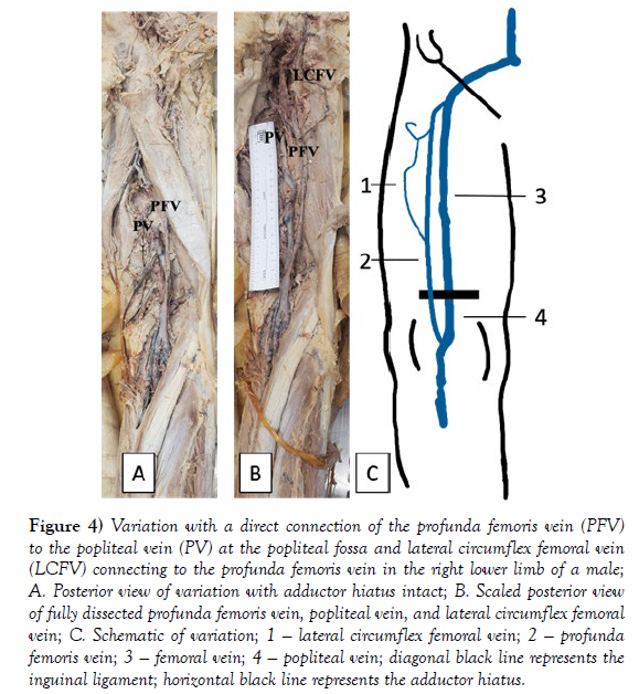 international-journal-anatomical-variations-profunda