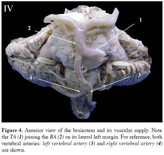 Anatomical-Variations-Anterior-view-brainstem