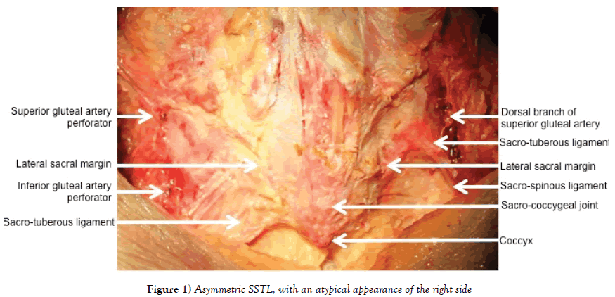 Anatomical-Variations-Asymmetric-SSTL