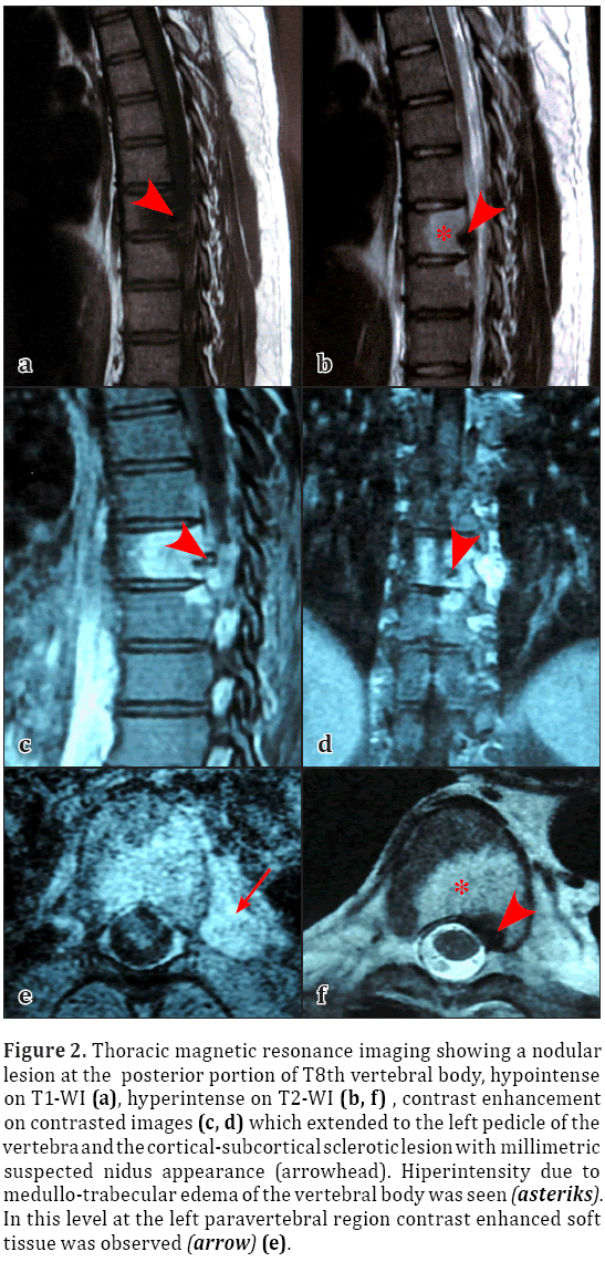 Osteoid Osteoma Of The Vertebral Body: An Unusual Localization