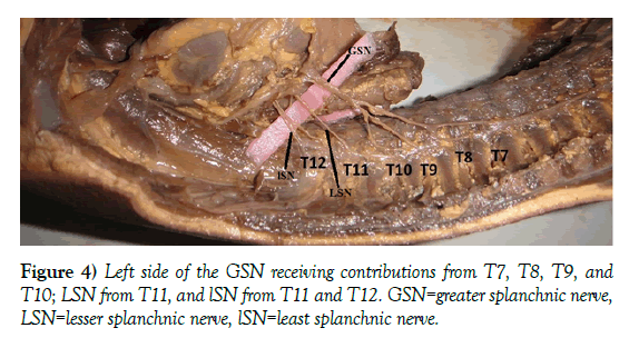 anatomical-variations-GSN