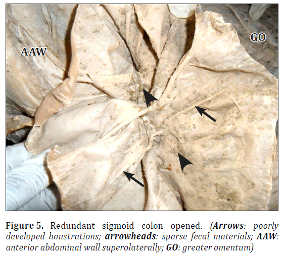 Pre-omental epigastric redundant sigmoid colon: a case report and ...