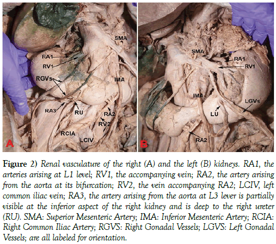 anatomical-variations-Renal-vasculature
