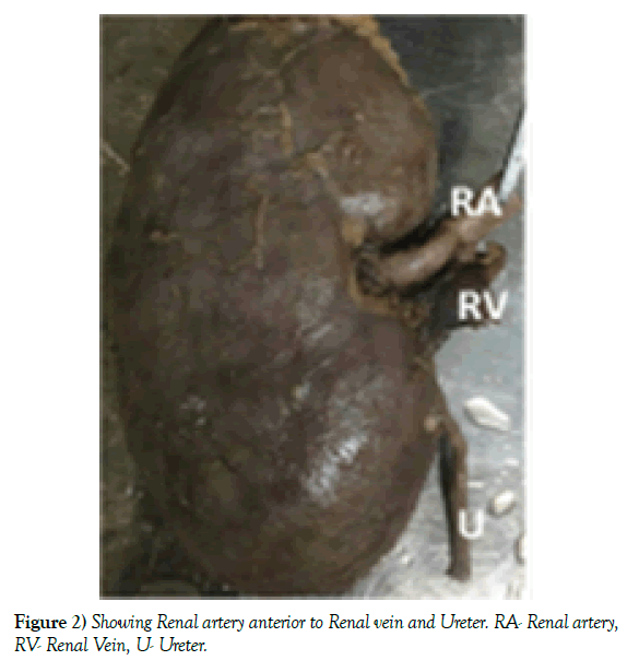 anatomical-variations-Renal-vein