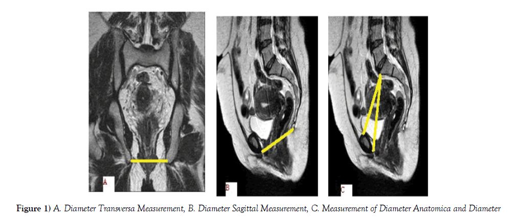 anatomical-variations-Transversa-Measurement