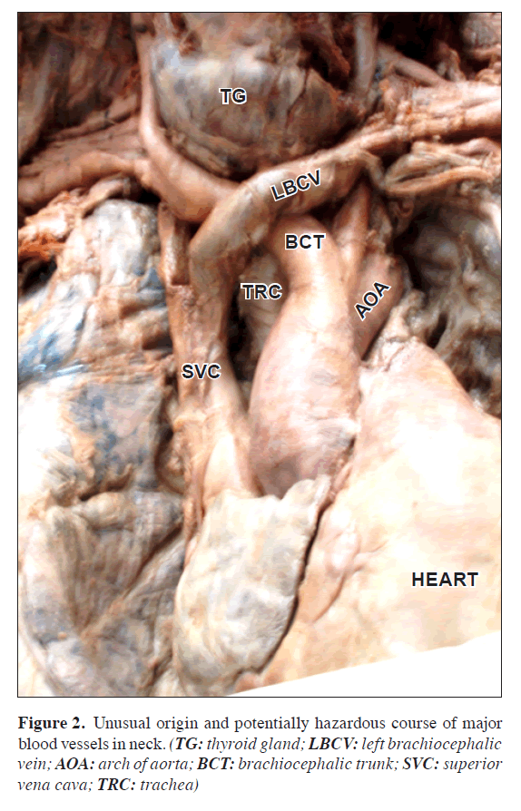 brachiocephalic trunk cadaver