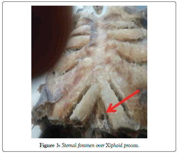 anatomical-variations-Xiphoid-process