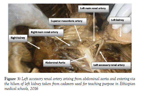 anatomical-variations-abdominal-aorta