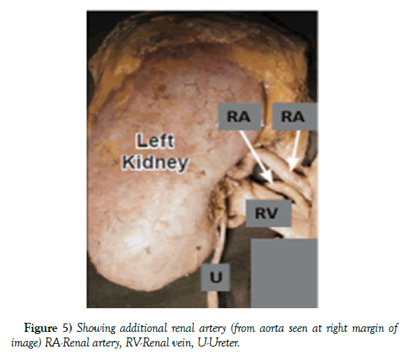 anatomical-variations-additional-renal