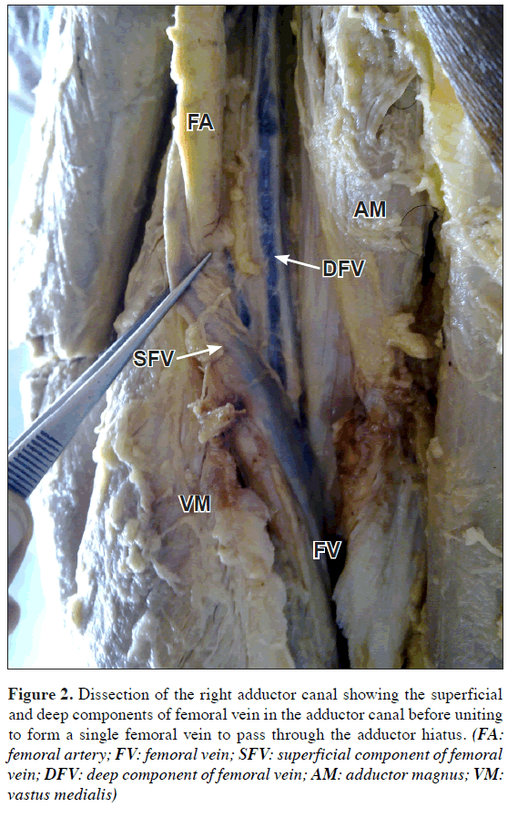 Duplication of femoral vein and its significant clinical implications