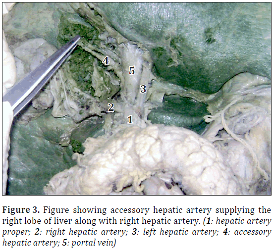 anatomical-variations-hepatic-artery