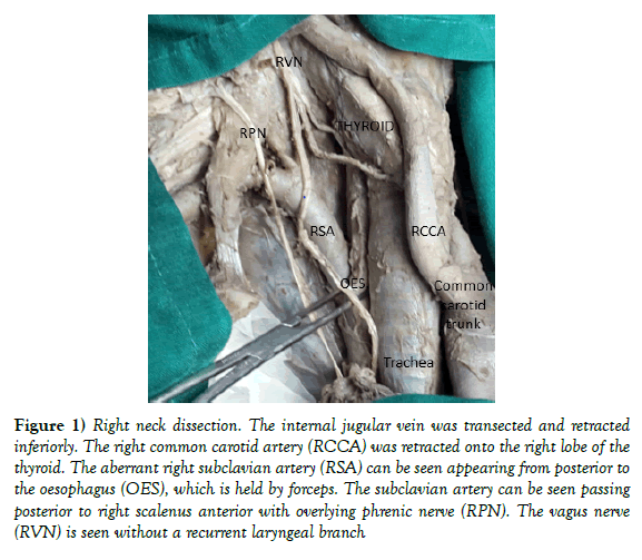 anatomical-variations-neck-dissection