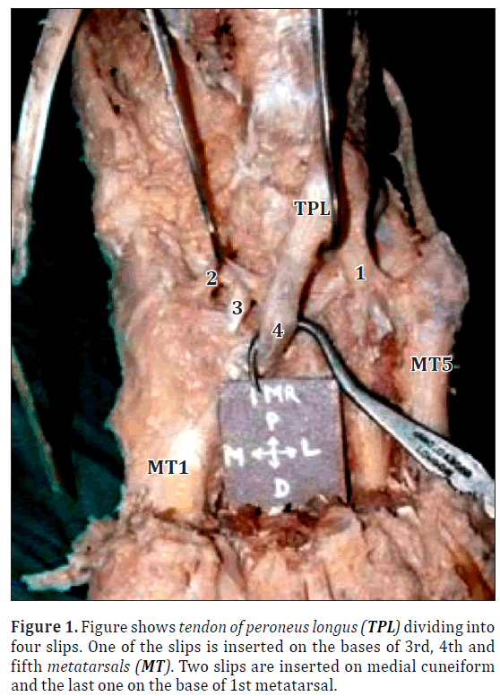 An anatomic variant insertion of peroneus longus in a ...