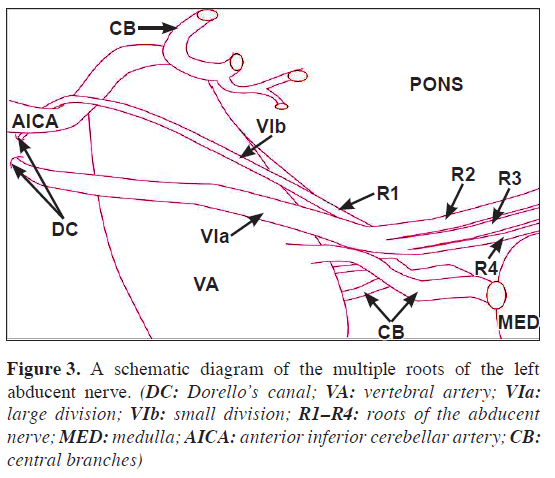 Four roots of abducent nerve at its exit from the pontomedullary sulcus ...