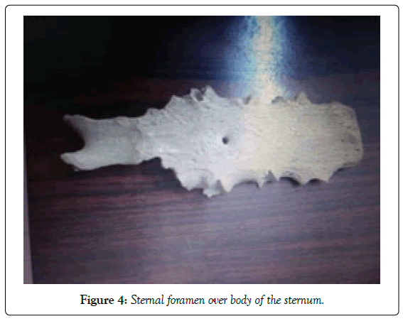 anatomical-variations-sternum