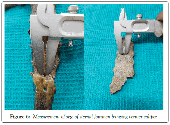 anatomical-variations-vernier-caliper