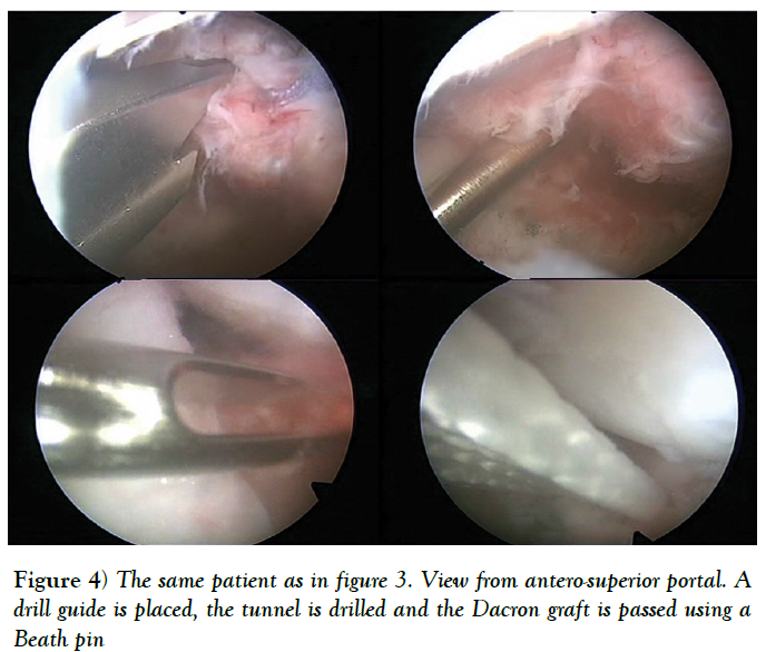 cinical-diagnosis-treatment-antero-superior-portal