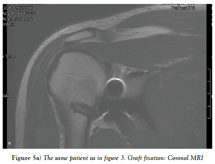 cinical-diagnosis-treatment-graft-fixation