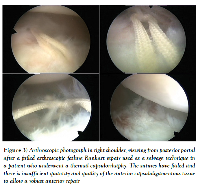 cinical-diagnosis-treatment-thermal-capsulorrhaphy