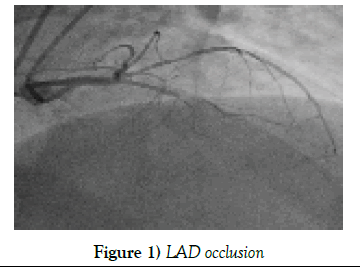 clinical-cardiology-LAD-occlusion