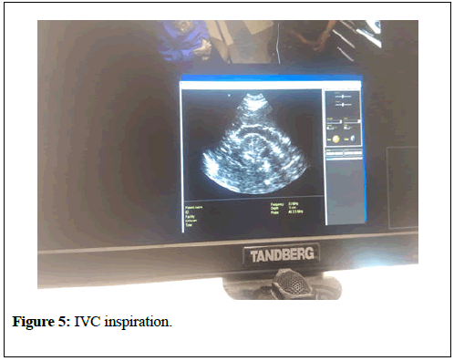 clinical-nephrology-IVC-cyst