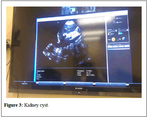 clinical-nephrology-Kidney-cyst