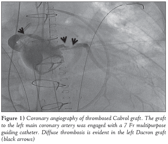 current-research-cardiology-Coronary-angiography