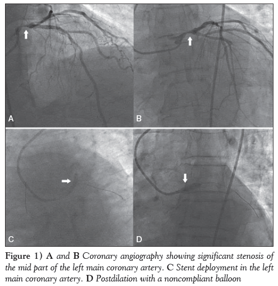 current-research-cardiology-Coronary-angiography