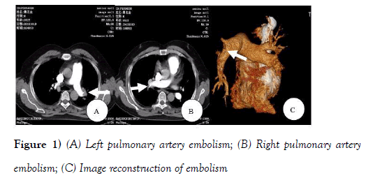 current-research-cardiology-Left-pulmonary-artery