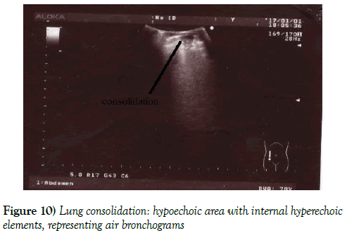 current-research-cardiology-Lung-consolidation