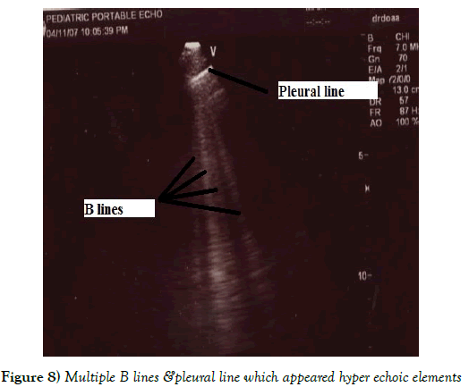 current-research-cardiology-hyper-echoic-elements