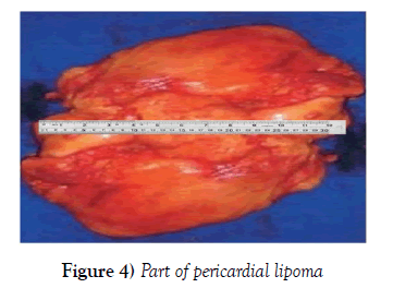 current-research-cardiology-pericardial-lipoma