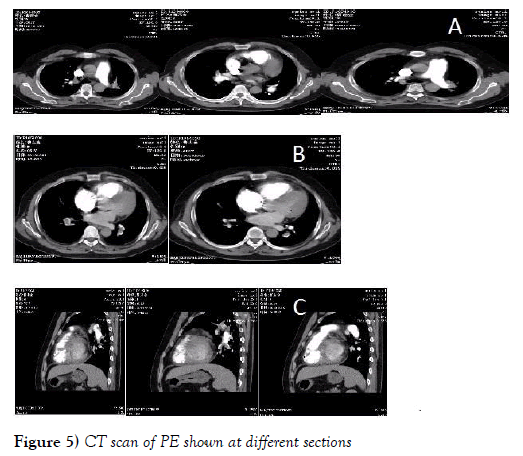 current-research-cardiology-scan-PE