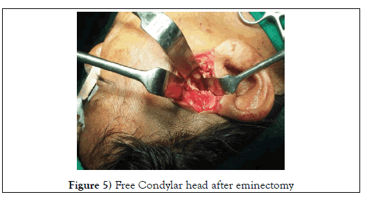 dental-oral-Condylar